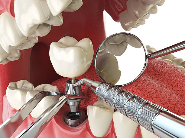 Best Emergency Dental Care for Broken or Chipped Teeth in Nevada, IA